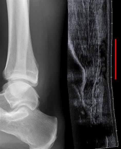 An Achilles tendon on ultrasound with a red line marking a rupture, beside an X-ray that rules out a bone injury.