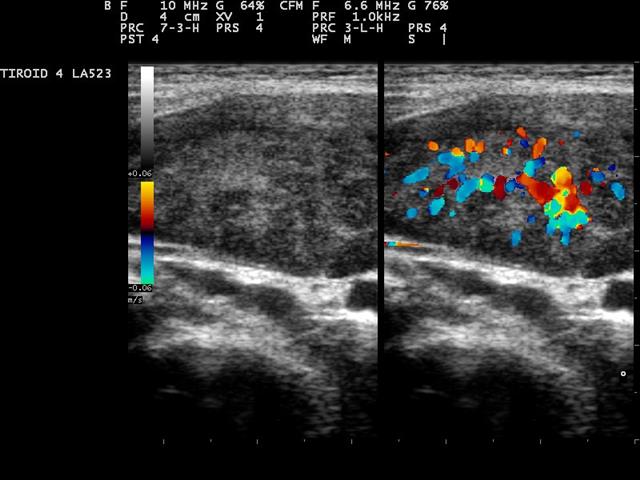 A thyroid gland scanned at 10 megahertz, greyscale on the left and colour Doppler of its blood flow on the right.