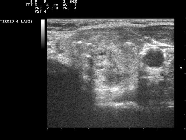 A transverse linear-probe ultrasound of the thyroid gland, a dark nodule visible on one side.