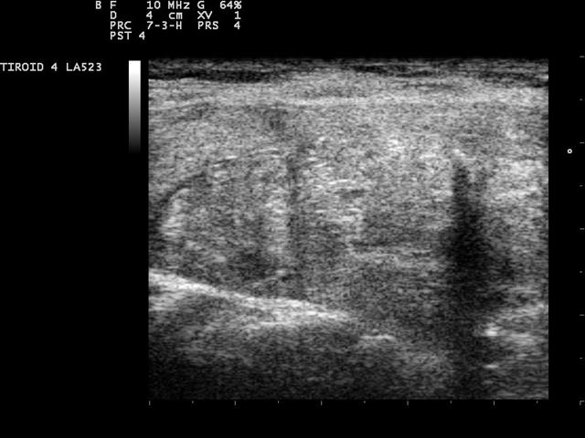 A thyroid gland on a high-frequency linear ultrasound, the gland tissue in fine greyscale detail.
