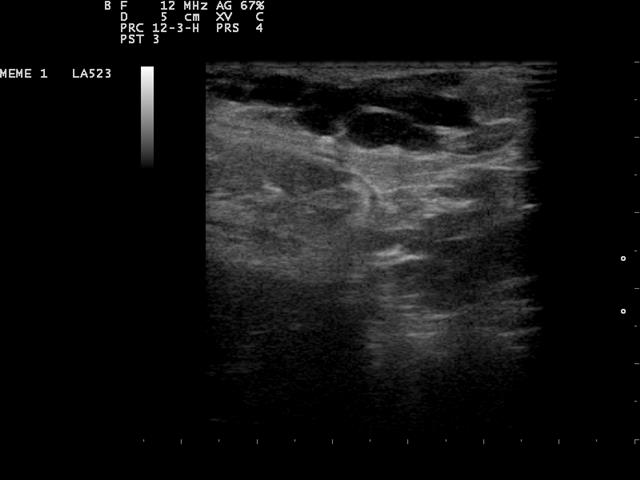 A breast lesion on a 12-megahertz linear ultrasound, a dark structure set in the surrounding tissue.
