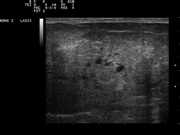A linear-probe ultrasound image, a rectangular field of superficial breast tissue with fine even detail.