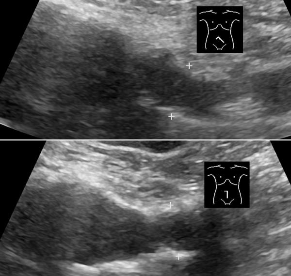 A convex-probe ultrasound image, a fan-shaped field reaching deep to show the common iliac arteries.
