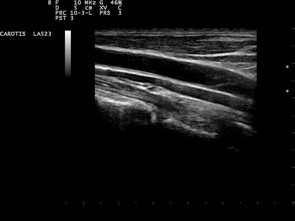 A greyscale B-mode ultrasound of a carotid artery, the vessel wall and lumen in plain grey.