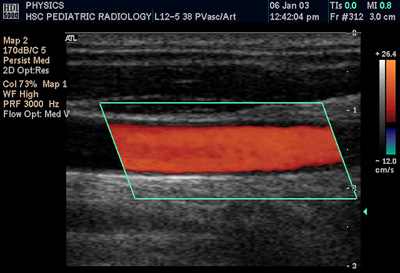 A color Doppler ultrasound of a carotid artery, blood flow overlaid in colour on a greyscale scan.