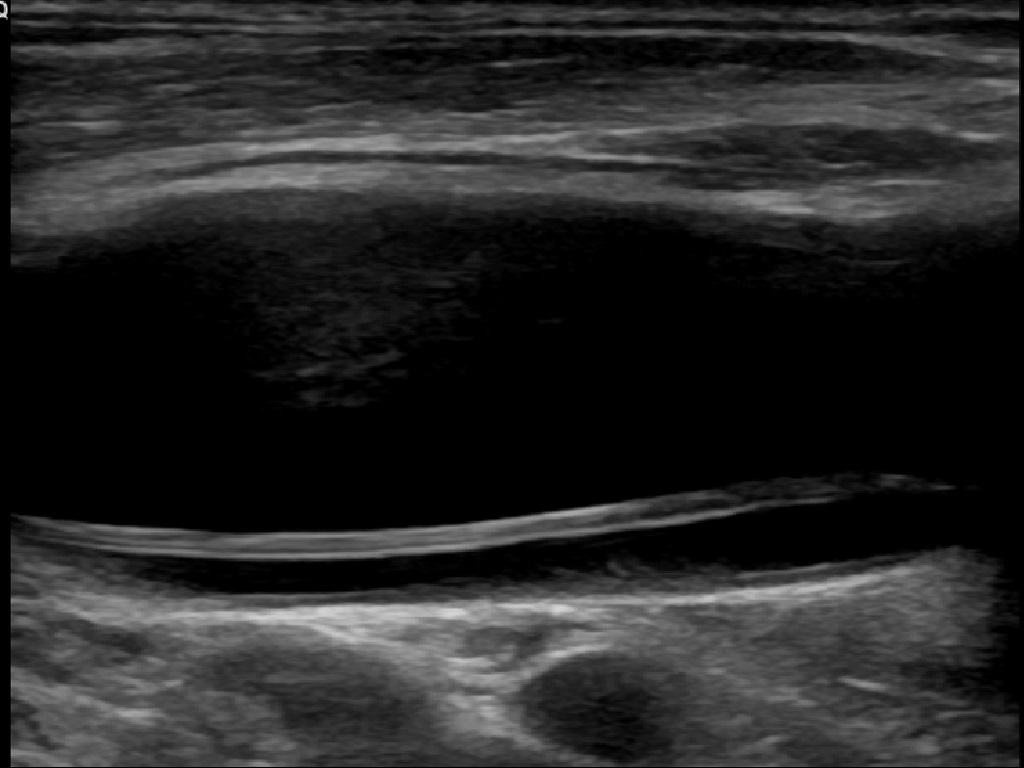 Two neck vessels as dark channels on a linear-probe ultrasound