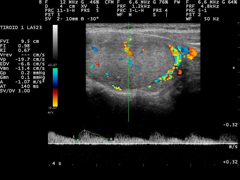 Thyroid on a linear probe with color Doppler and a pulsed-wave trace