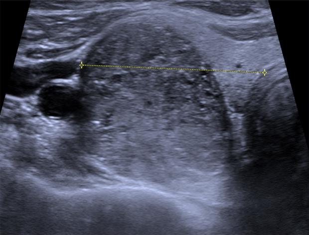 An ultrasound of a papillary thyroid carcinoma, scattered bright punctate microcalcifications inside the nodule.