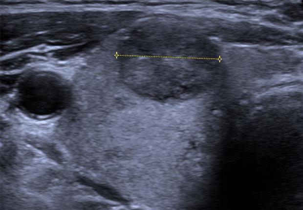 An ultrasound of a benign hyperplastic thyroid nodule, moderately low in echo, measured with on-screen calipers.