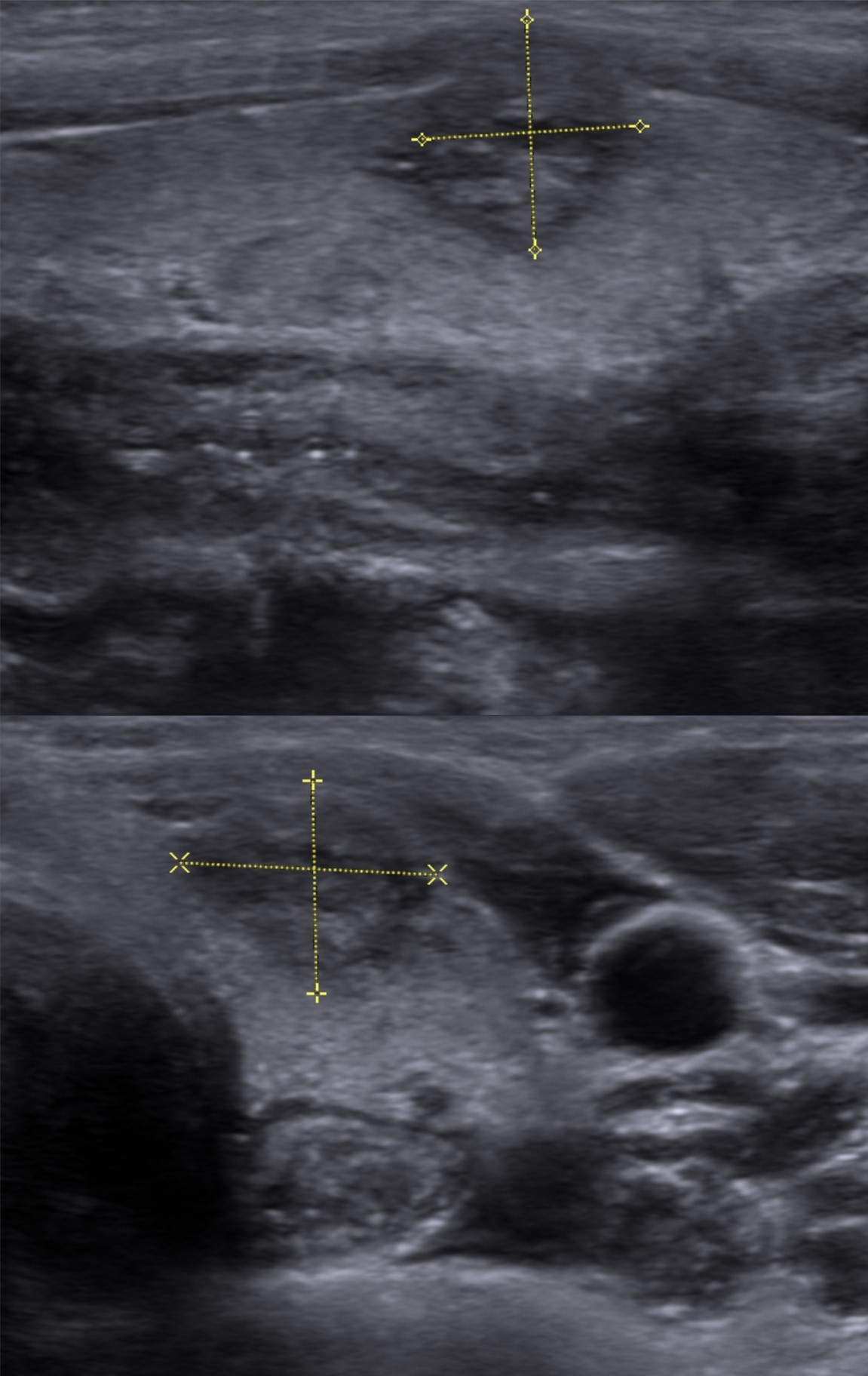 Hypoechoic thyroid cancer measured in two planes
