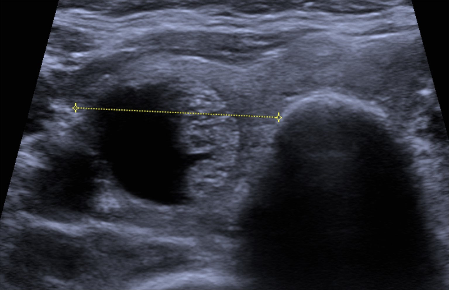 Benign macrofollicular nodule with cystic spaces