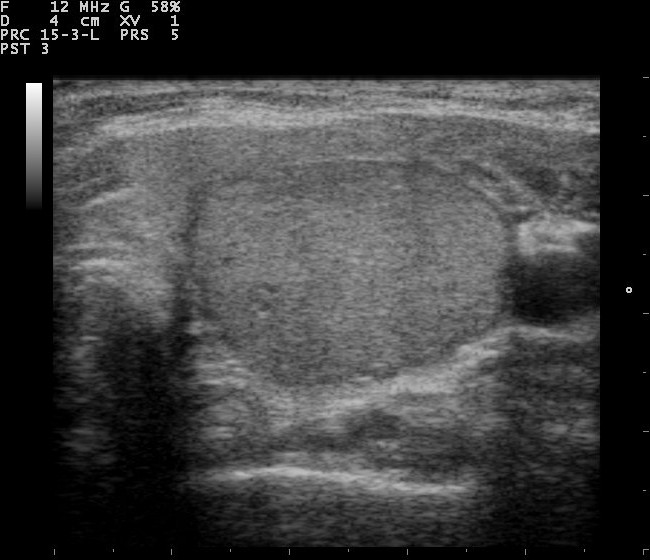 Thyroid nodule on ultrasound, the target of a guided FNA