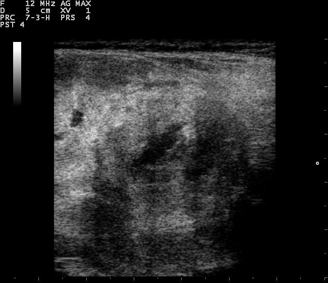 Hypoechoic thyroid nodule on ultrasound