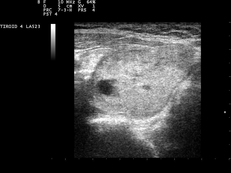 Hypoechoic thyroid nodule with an unclear margin