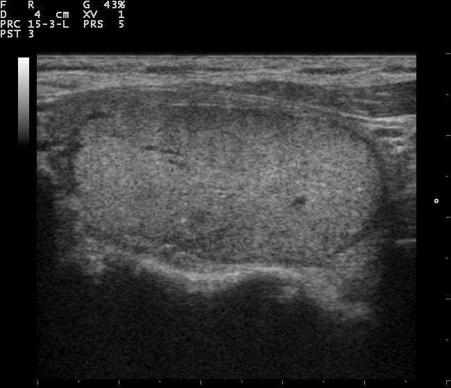 Bland evenly solid thyroid nodule with a smooth border