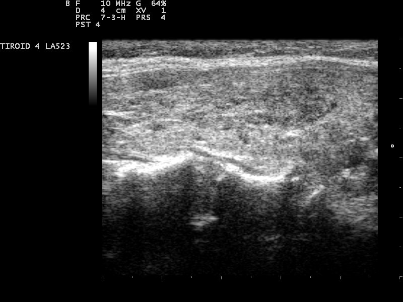 Hashimoto thyroiditis diffuse hypoechoic heterogeneous gland