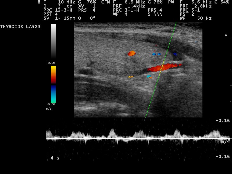 Color Doppler of a Hashimoto gland showing the giraffe pattern