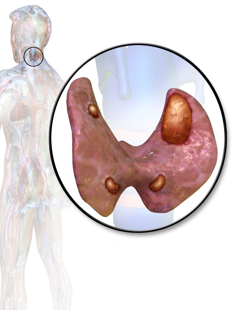 Parathyroid adenoma anatomy behind the thyroid