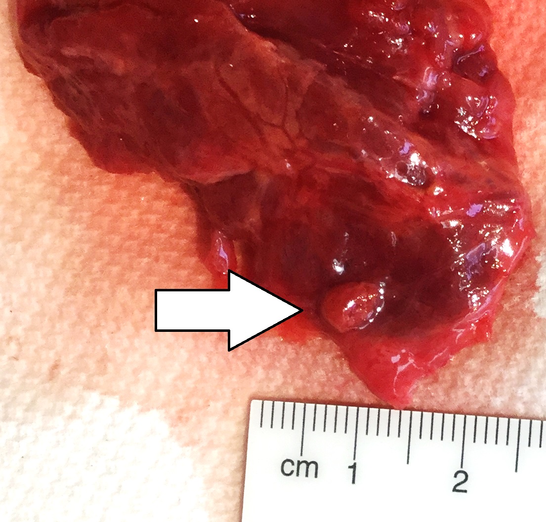 Resected parathyroid adenoma with a centimeter scale