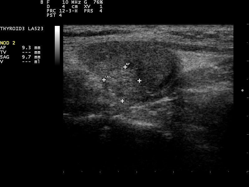 A thyroid nodule measured with calipers on a linear probe