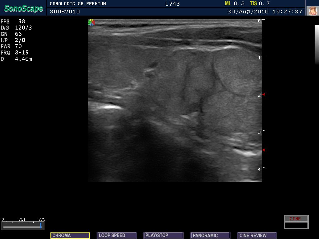 A thyroid gland with the coarse texture of Hashimoto thyroiditis