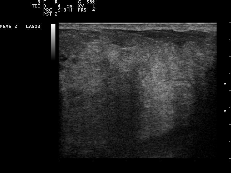 Hypoechoic breast mass on ultrasound