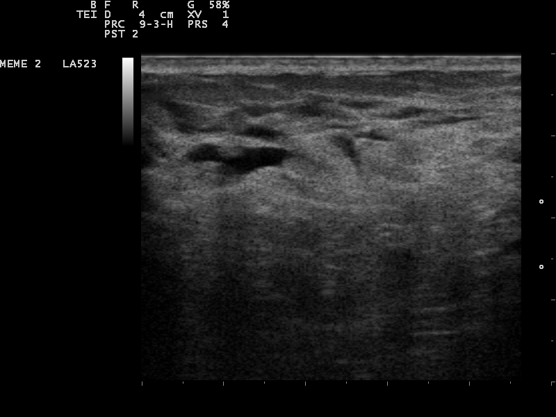 Small anechoic cysts in the breast on ultrasound