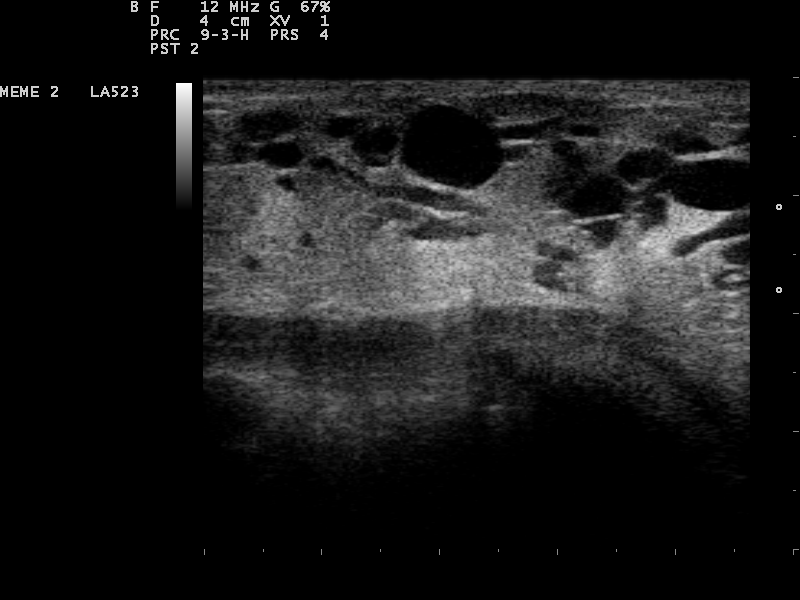 Multiple anechoic breast cysts on ultrasound