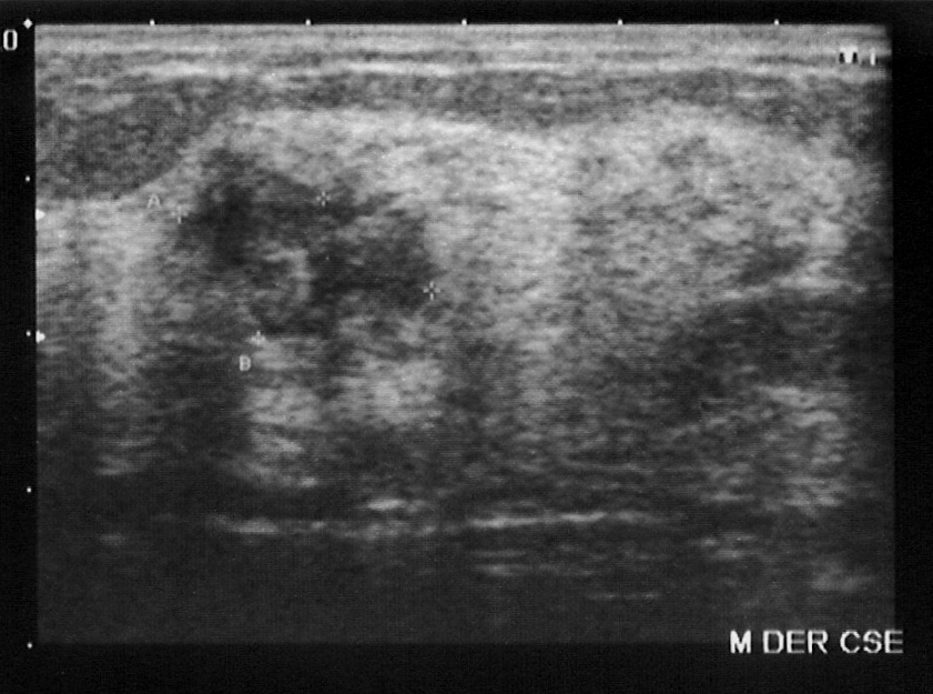 Irregular hypoechoic breast mass on ultrasound