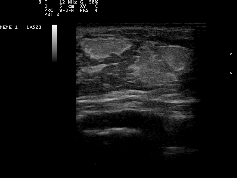 Breast mass on ultrasound with planned flat needle path