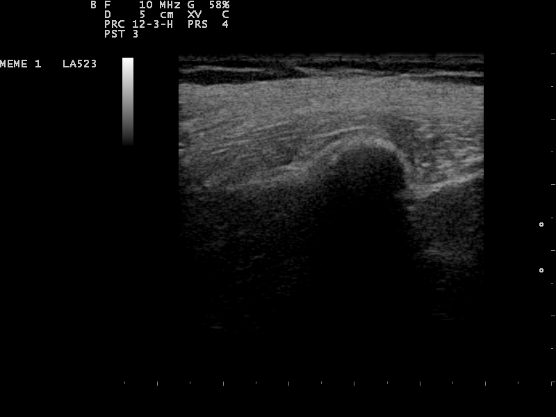 Hypoechoic breast mass on ultrasound, a core biopsy target