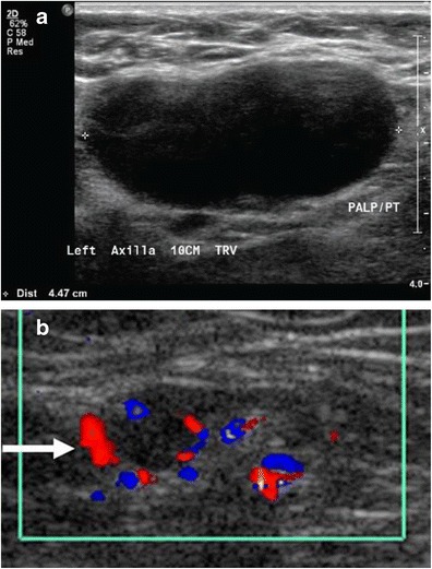 Suspected malignant axillary lymph node grayscale and color Doppler