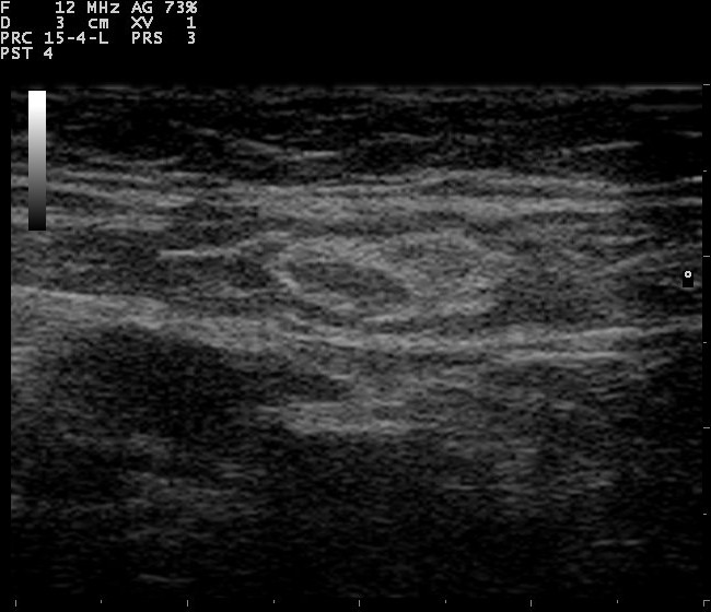 Normal lymph node with fatty hilum and thin cortex on ultrasound