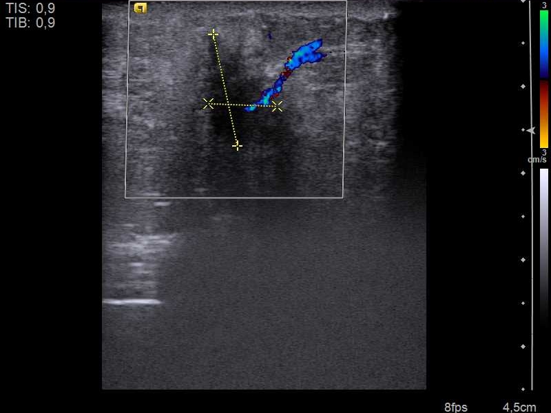 A breast cancer on ultrasound with color Doppler and calipers