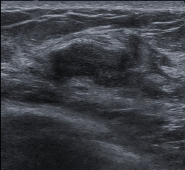 A benign fibroadenoma on breast ultrasound, a smooth oval