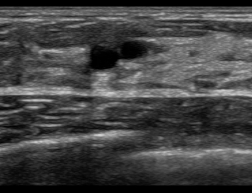 Two small anechoic breast cysts on ultrasound