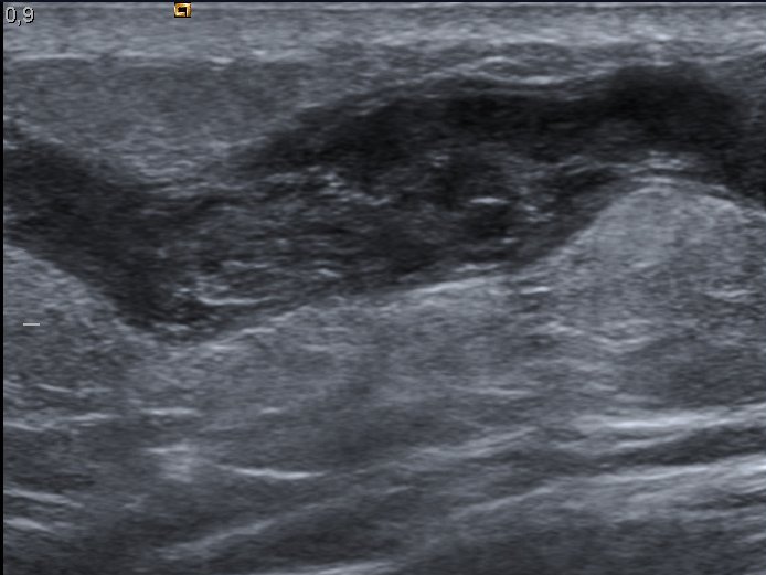 A vein seen in long axis on ultrasound, a lengthwise corridor