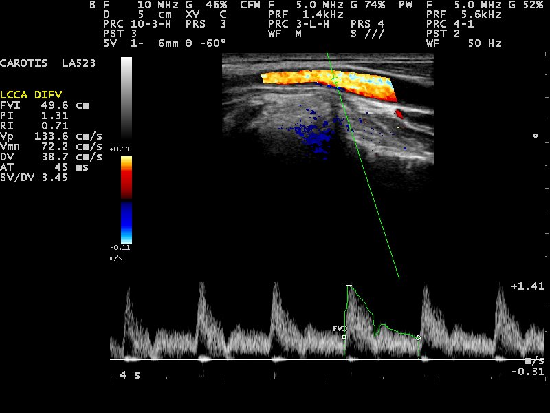 A carotid artery seen in long axis with color flow