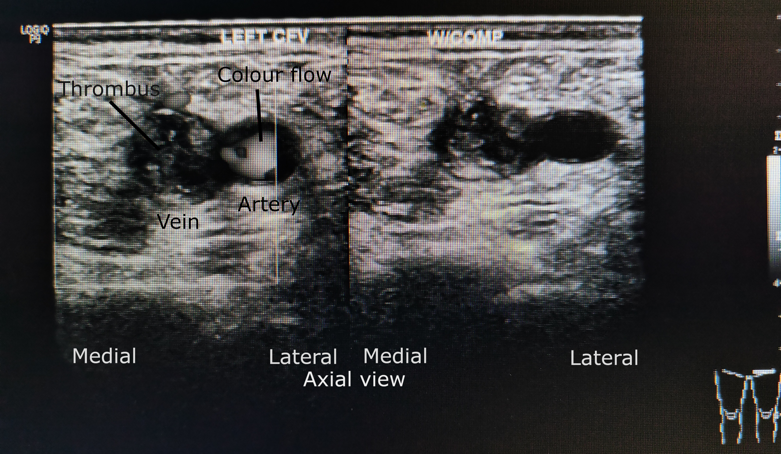 Ultrasound of a femoral vein and artery with colour flow