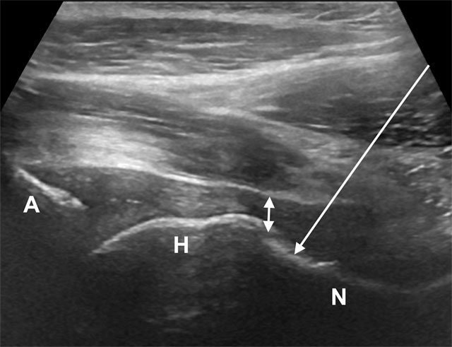 Ultrasound of an in-plane needle approach to a deep joint