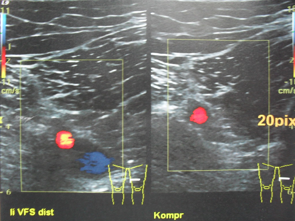 Ultrasound of a femoral vein before and during compression, the vein vanishing