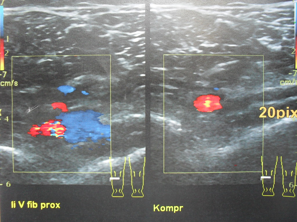 Ultrasound of a deep calf vein compressing shut under the probe