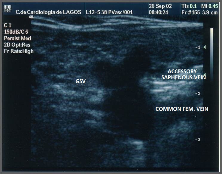 Transverse ultrasound of a vein and artery side by side