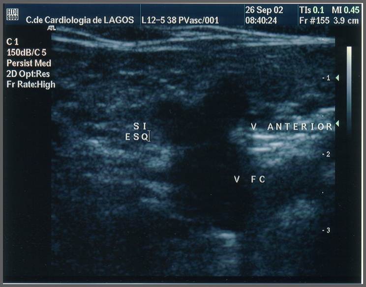 Deep vein as a dark circle on transverse ultrasound