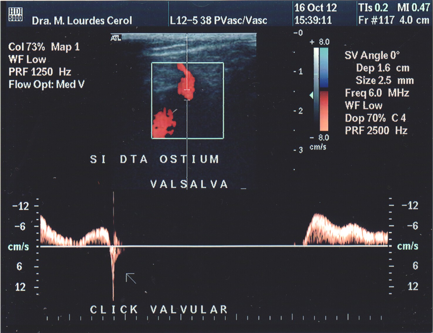 Vein on ultrasound with colour and spectral Doppler
