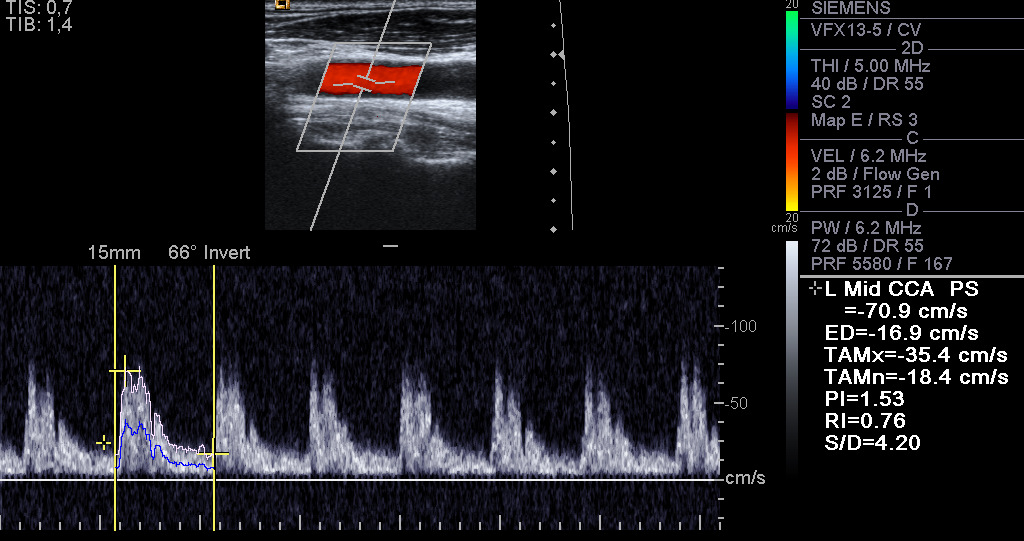 Artery with colour and spectral Doppler on ultrasound