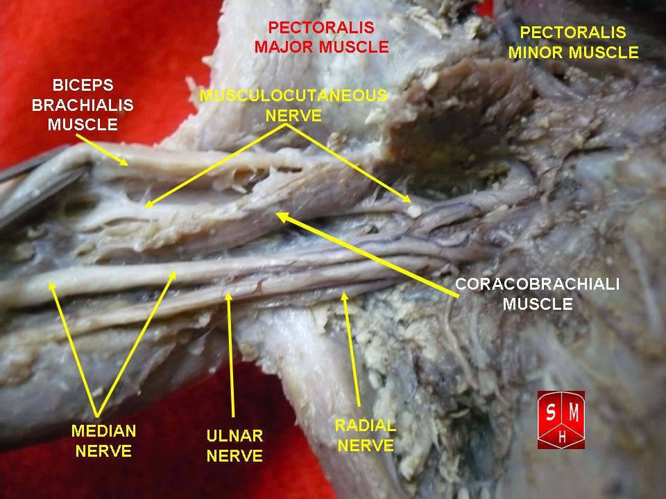 Dissection of the arm nerves branching from the brachial plexus