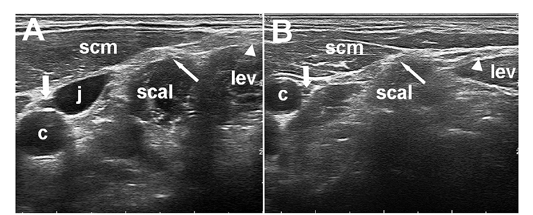 Ultrasound cross-section of the vagus nerve in the neck beside the carotid and jugular