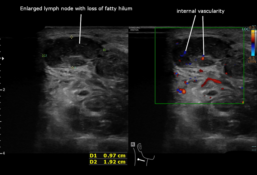 Neck lymph node with loss of fatty hilum and abnormal internal flow