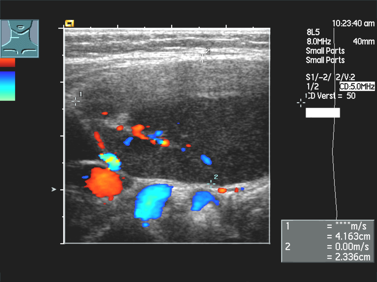 Large dark lymphoma node in the neck with colour Doppler flow
